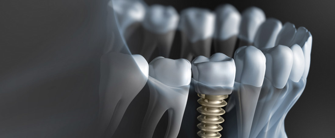 Implantologie Header